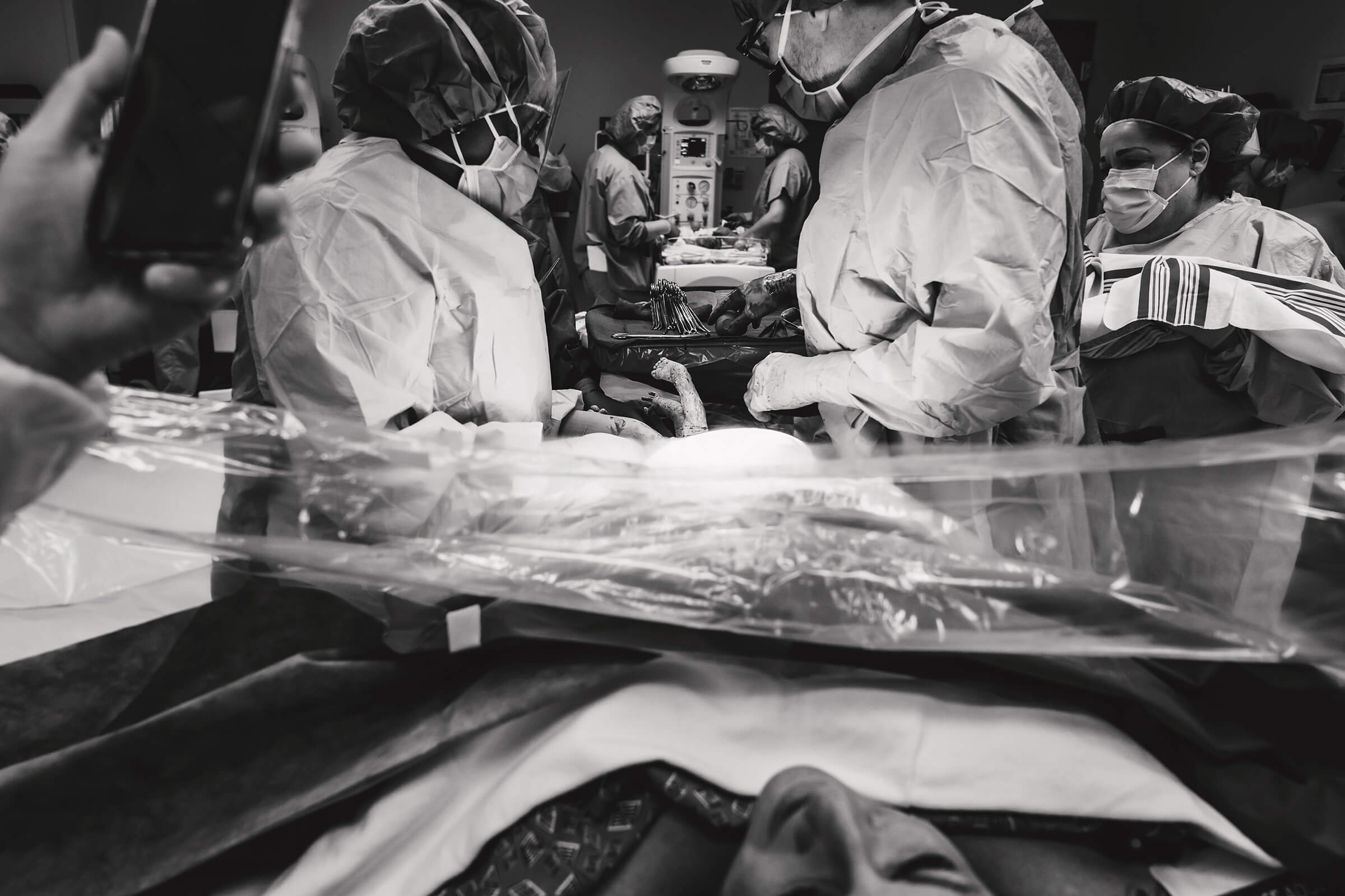 delivery of twin B in breech position by c-section 